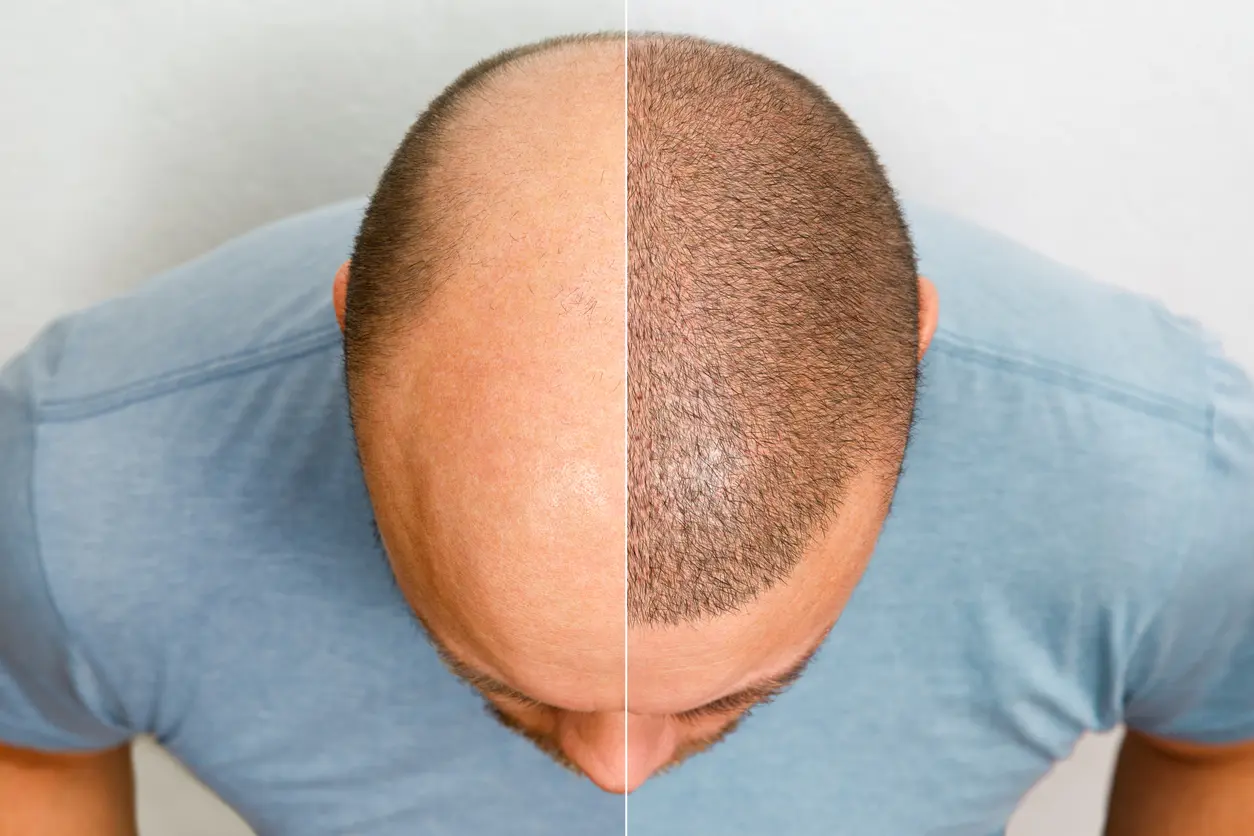 Alopecia Masculina: Entenda as Razões e Encontre Soluções Eficazes